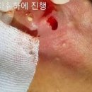 왼쪽 오른쪽 귀뒤 통증 멍울 원인 이미지