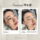 신안로 | 진주 신안동 피부관리, "아누보" 화이트 토닝 관리 솔직한 후기