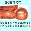 심장동맥심장병의 이해 이미지