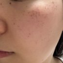 루비약국 | [압구정 루비레이저로 유명한 피부과] 주근깨&amp;잡티 치료 후기, 사전 준비물