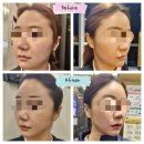 비포앤애프터 프라이빗짐 | 땡김이주사 로 볼살 관리했어요 윤곽주사와 비교후기
