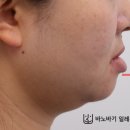 도일아나파치과의원 | 성인 반대교합 교정 "비대칭이 좋아질 수 있나요?" (비수술 주걱턱 교정 후기)