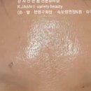 강자안손톱 이미지