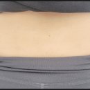 광주지흡흉터로 유명한 스킨새로이 솔직 후기