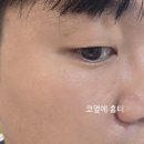 콜드플라즈마 | [대구/중구] 플라즈마에스테틱 콜드 플라즈마 체험 후기