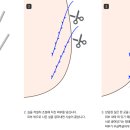 미사랑의원 | [대구성형외과] 녹는실 민트실리프팅 (마이리프팅) 2주 후기 연세미사랑의원