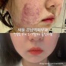 서울 강남피부과에서 인모드FX 받고온 일주일 후기