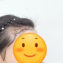 일층약국 | m자 헤어라인 3500모 모발 이식 수술! 엄청 자세한 후기 (당일~2주차 기록, 비용 견적, 통증, 휴가...
