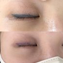 세종SJ타워앞 | [후기] 아이라인,눈썹 문신제거 1회차 세종블리즈미 (내돈내산)