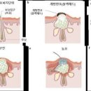 여드름 종류를 살펴보고 다르게 관리해 보세요! 이미지