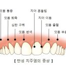 만성치주염 증상과 치료 이미지