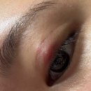 채움약국 | 짝눈 비절개 매몰 쌍수 후기🥹-겉다래끼 나며 한 달 채움