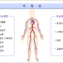 저혈압(hypotension) 이미지