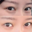 그린외과의원 | 강남역하니성형외과 눈뒷밑트임 (써클트임) 가격, 통증, 붓기 총정리 후기