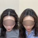 매소홀로 | 인천두피문신 여자 가르마커버 혜지오 인천점 솔직후기