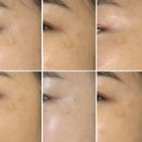 좋은아침약국 | 먹는 기미약 트란시노2정 기미 없애는 방법 한 달 복용 후기