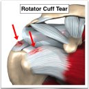 어깨 MRI (Shoulder MRI) 영상 진단 이미지