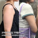 교대지방흡입 3개월 교대팔지방흡입 부유방제거 일상생활 후기