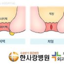 초기치질증상 치질은 초기에 치료해야 합니다 이미지