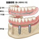 미소심는치과의원 | 서초역 치과 임플란트 틀니 VS 일반 틀니 나에게는?