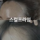 스칼프라임SMP | 스칼프라임 | 쌍용동 두피 SMP 꼼꼼하게 잘하는곳 | 천안탈모커버