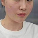 엠레드의원 | 얼굴실리프팅 잼버실&amp;아이쓰레드실 붓기 효과 후기 엠레드의원