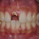 정성가득미소치과의원 | 의왕 오전동치과, 부러진 20대 여성의 앞니... 발치 없이 감쪽같이 살린 심미보철 후기