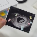 나이스 | 임신 11주차 1차 기형아검사 니프티 나이스 검사 후기 + 어지럼증