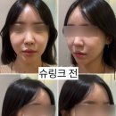 탱글성형외과의원 | 슈링크 효과 시기 리프팅 후기 + 통증, 가격, 부작용, 주기