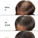 모타브 | 가르마 정수리 두피문신 횟수 두피상태에 따라 달라져야 하는 이유