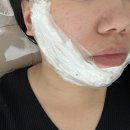 부산 해운대한의원 트러블 컨택터로 여드름흉터치료 후기