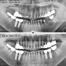 연세대야S치과의원 | 씹을 때 턱아픔 어금니 통증 아픔, 욱신, 잇몸 뿌리 염증 부음_임플란트 후기