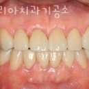 ONE치과기공소 네이버블로그