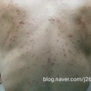 백인정형외과의원 | 갑자기 가슴과 등에 여드름 같은 것이 쫙 퍼졌는데, 요새 먹은 약 때문일까요? (스테로이드여드름)
