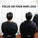 나는 소년이었다 SMP | 50대 남성 가르마&amp;정수리 탈모 두피문신(SMP) 후기와 전문 정보. 망원동 합정 홍대 나는 소년이었다 SMP