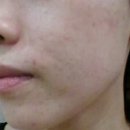 정안탕 | &lt;매선&gt;&lt;부산 한방성형&gt;&lt;동안침&gt;&lt;정안침&gt;&lt;부산 매선&gt;매선시술후기