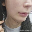 이천톡스앤필의원 | [내돈내산] 볼뉴머300샷+쥬베룩볼륨2cc 이천 피부과 추천