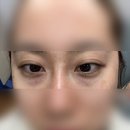 이노필 | 눈밑지 레이저, 눈밑지방재배치 레이저 후기, 의정부성형외과