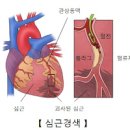 급성 심근경색 전조 미리 알아보고 대처 및 예방 관리하는 법 이미지