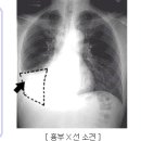 늑막염(Pleurisy) 이란 이미지