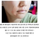 장미별장여관 | 팔자주름보톡스말고 간단한 해결방법이?!