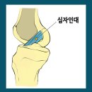 무릎통증, 무릎수술, 관절내시경, 십자인대파열, 십자인대수술 이미지