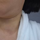청담디어 | 청담공의원 가로목주름 주사 후기 디어넥주사 직접 받아봤어요 아직시술중