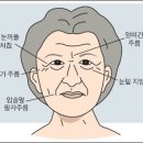 [몸과마음] 눈꺼풀 올려주는 안검성형술 이미지