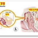 전정 신경염[vestibular neuritis] 이미지