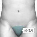 무른 궤양(Chancroid)감염성 질환이란? 이미지