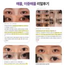 첫눈성형외과의원 네이버블로그
