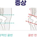 라인업 체형교정 이미지