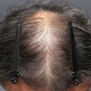 대방성 | 신대방탈모병원 후기｜탈모약 부작용 경험 후 선택한 치료