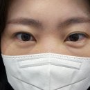 [내돈내산] 눈밑지방재배치 후기/진행경과/만족도/병원선택/사전준비물 (추천!)